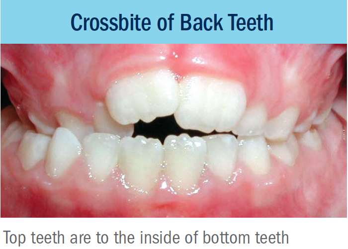How To Treat Crossbite In Adults